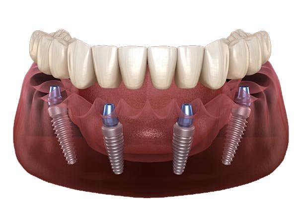 All-On-4-Implants-in-