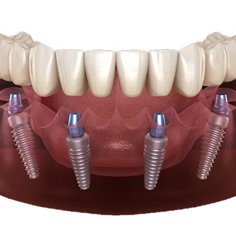 All-On-4-Implants-in-